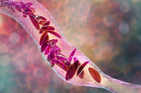 Red blood cells affected by sickle cell disease.
